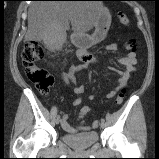 Acute cholecystitis and ureteric colic (Radiopaedia 42330-45444 Coronal prone 43).jpg