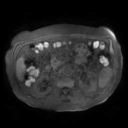 Acute cholecystitis complicated by pylephlebitis (Radiopaedia 65782-74915 Axial T1 fat sat 74).jpg