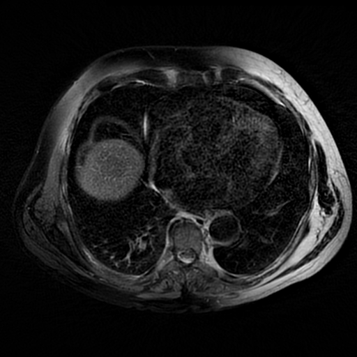 File:Acute cholecystitis complicated by pylephlebitis (Radiopaedia 65782-74915 Axial T2 fat sat 2).jpg