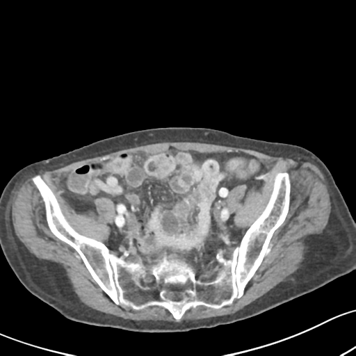 Acute cholecystitis with contained perforation (Radiopaedia 47328-51907 Axial C+ portal venous phase 56).png