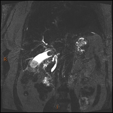 File:Acute cholecystitis with gallbladder neck calculus (Radiopaedia 42795-45971 Coronal Turbo spin echo 17).jpg