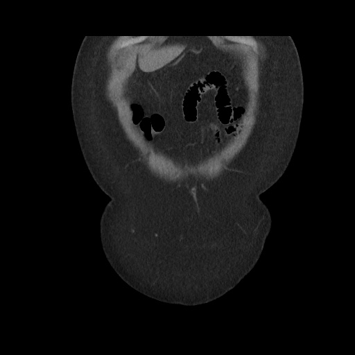 Acute cholecystitis with tensile fundus sign (Radiopaedia 71394-81723 Coronal non-contrast 25).jpg