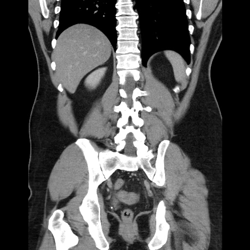 Acute diverticulitis with localized perforation (Radiopaedia 41296-44113 Coronal C+ portal venous phase 46).jpg