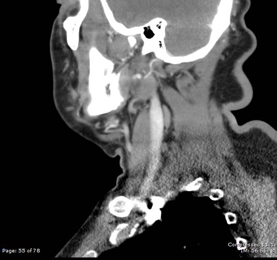 Acute epiglottitis (Radiopaedia 54375-60590 Sagittal C+ arterial phase 55).jpg
