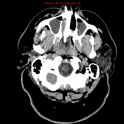 Acute hemorrhagic leukoencephalitis (Radiopaedia 14076-13920 Axial non-contrast 1).jpg