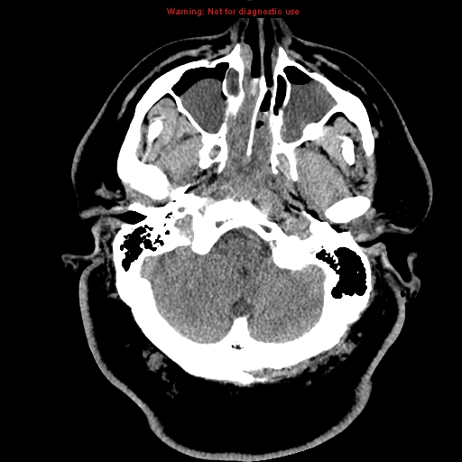 Acute hemorrhagic leukoencephalitis (Radiopaedia 14076-13920 Axial non-contrast 5).jpg