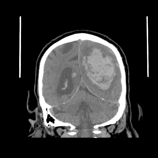 File:Acute hemorrhagic stroke (Radiopaedia 17507-17223 Coronal non-contrast 38).jpg