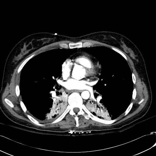 File:Acute myocardial infarction in CT (Radiopaedia 39947-42415 Axial C+ arterial phase 76).jpg