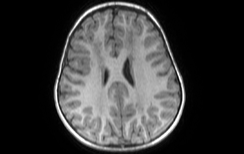 Acute necrotizing encephalitis of childhood (Radiopaedia 67356-76737 Axial T1 31).jpg