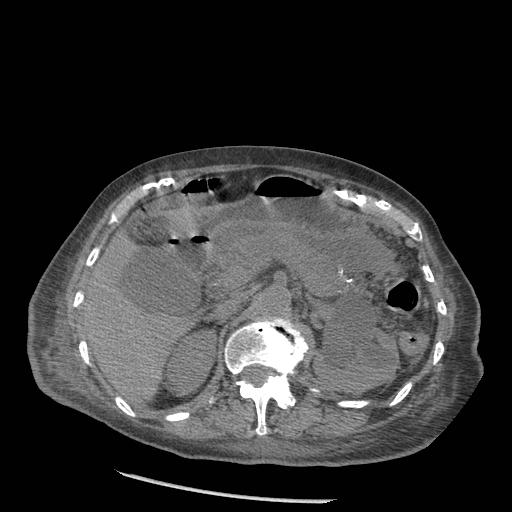Acute on chronic pancreatitis (Radiopaedia 13233-13244 Axial non-contrast 31).jpg