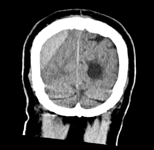 Acute on chronic subdural hematoma (Radiopaedia 78346-90966 Coronal non-contrast 57).jpg