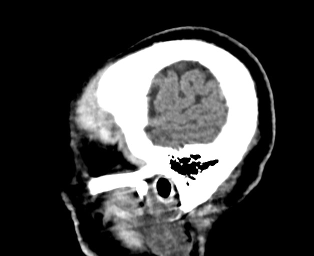 Acute on chronic subdural hematoma (Radiopaedia 78346-90966 Sagittal non-contrast 11).jpg