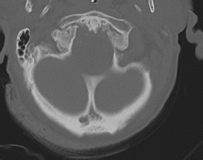 Acute on chronic subdural hematoma and thoracic vertebral injury in a multitrauma patient (Radiopaedia 31698-32619 Axial bone window 11).jpg