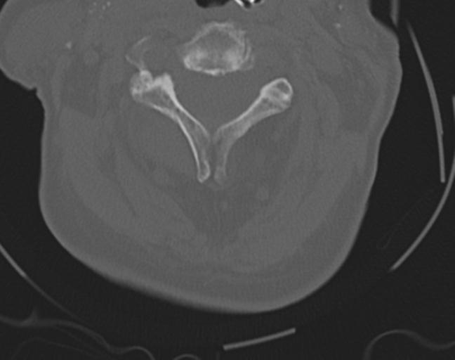 Acute on chronic subdural hematoma and thoracic vertebral injury in a multitrauma patient (Radiopaedia 31698-32619 Axial bone window 21).jpg