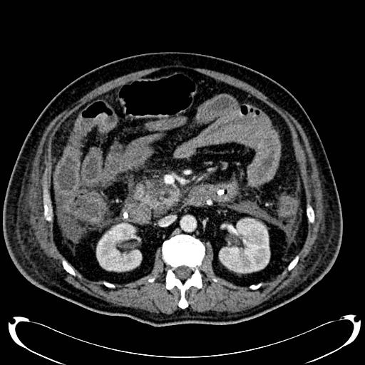 Acute pancreatic necrosis (Radiopaedia 13560-18500 Axial C+ portal venous phase 70).jpg