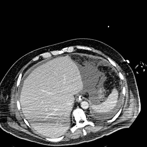 File:Acute pancreatic necrosis (Radiopaedia 13560-18501 Axial C+ portal venous phase 16).jpg