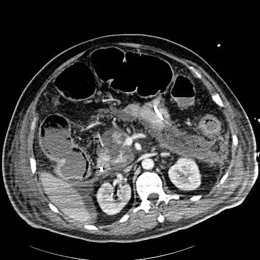Acute pancreatic necrosis (Radiopaedia 13560-18502 Axial C+ portal venous phase 32).jpg