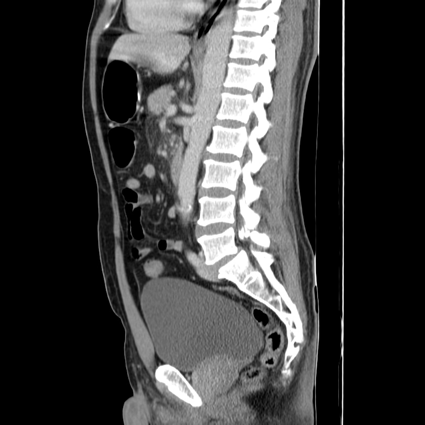 Acute pancreatitis (Radiopaedia 22572-22596 Sagittal C+ portal venous phase 30).jpg