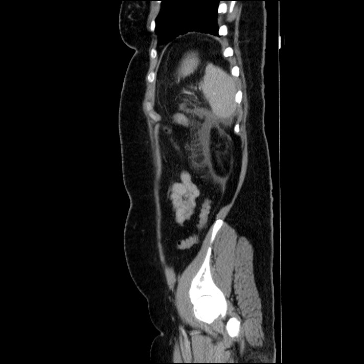 Acute pancreatitis (Radiopaedia 69236-79012 Sagittal C+ portal venous phase 27).jpg