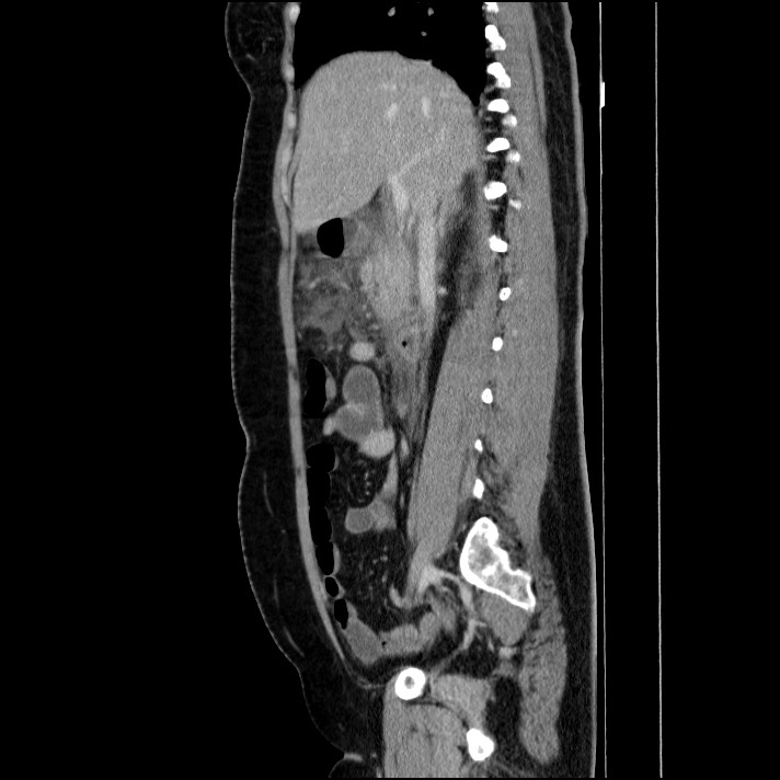 Acute pancreatitis (Radiopaedia 69236-79012 Sagittal C+ portal venous phase 62).jpg
