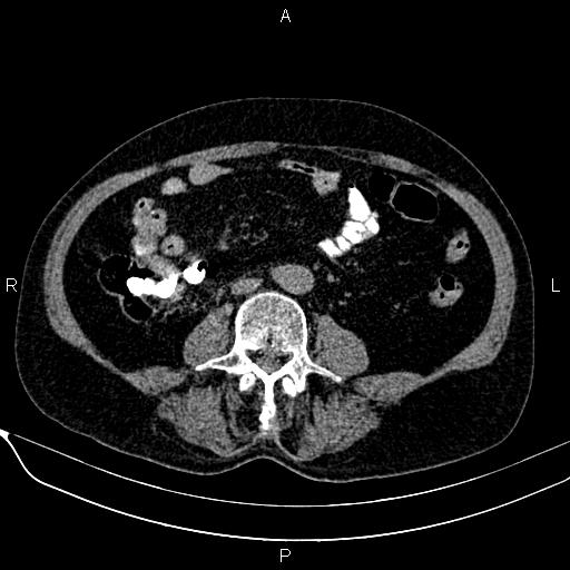Acute pancreatitis (Radiopaedia 85146-100701 Axial non-contrast 75).jpg