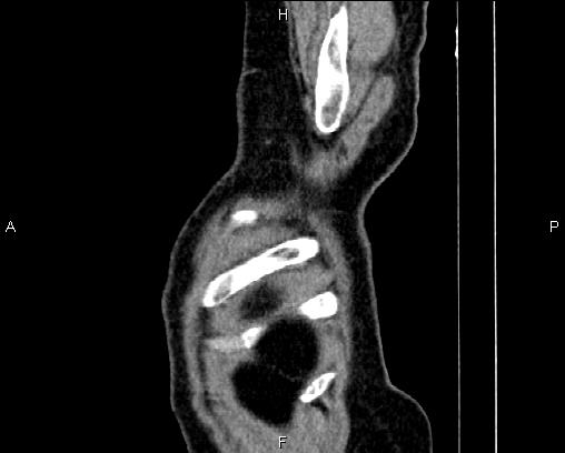Acute pancreatitis (Radiopaedia 85146-100701 Sagittal C+ portal venous phase 96).jpg