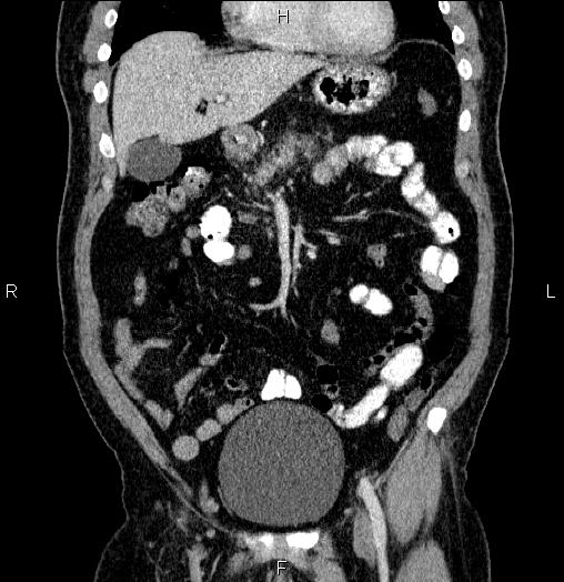 Acute pancreatitis (Radiopaedia 85390-101010 Coronal C+ portal venous phase 21).jpg
