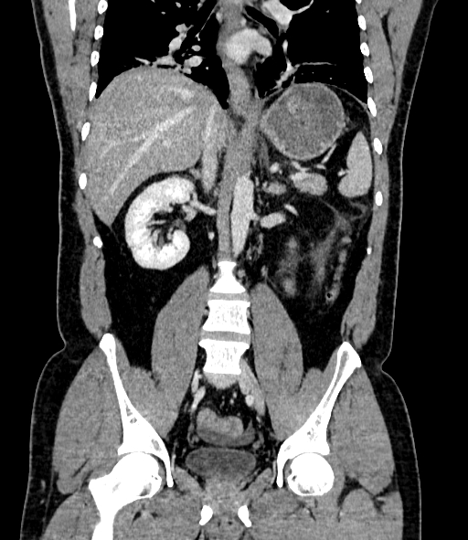 Acute pancreatitis (Radiopaedia 87428-103757 Coronal C+ portal venous phase 55).jpg