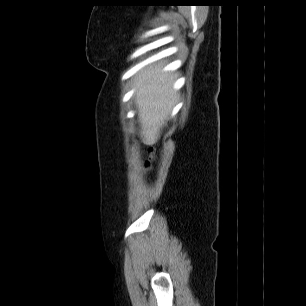 Acute pancreatitis - Balthazar C (Radiopaedia 26569-26714 Sagittal C+ portal venous phase 11).jpg