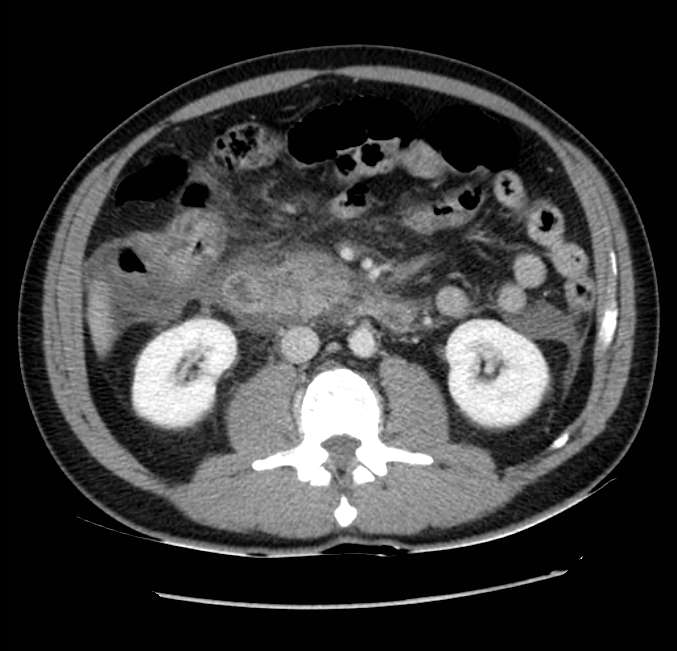 Acute pancreatitis - Balthazar E (Radiopaedia 23080-23110 Axial C+ portal venous phase 33).jpg