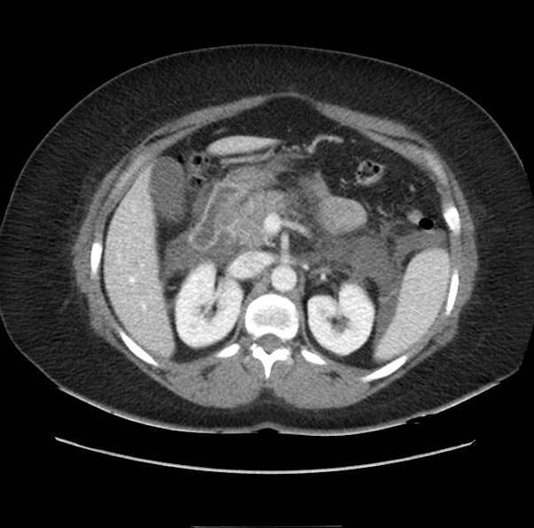 Acute pancreatitis - Balthazar E (Radiopaedia 29016-29377 Axial C+ portal venous phase 24).png