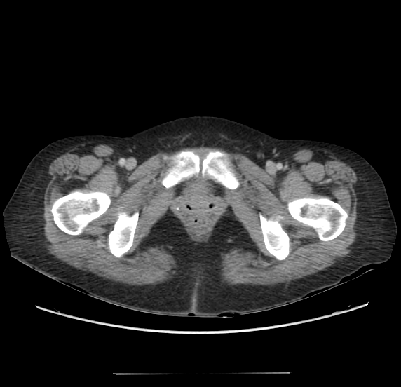 File:Acute pancreatitis - Balthazar E - post ERCP (Radiopaedia 27562-27772 Axial C+ portal venous phase 78).png