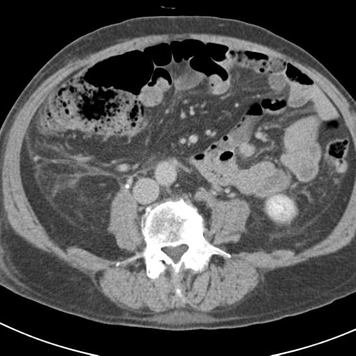 Acute pancreatitis and walled-off necrosis (Radiopaedia 29888-30403 Axial C+ delayed 49).jpg