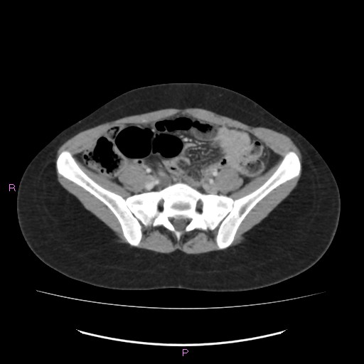 File:Acute pancreatitis secondary to stone at minor papilla and pancreatic divisum (Radiopaedia 76570-88333 Axial C+ portal venous phase 56).jpg