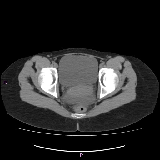 Acute pancreatitis secondary to stone at minor papilla and pancreatic divisum (Radiopaedia 76570-88333 Axial non-contrast 73).jpg