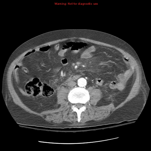 Acute pancreatitis with incidental pancreatic lipoma (Radiopaedia 10190-10730 Axial C+ arterial phase 61).jpg