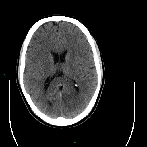 Acute posterior cerebral artery territory infarct (Radiopaedia 79329-92393 Axial non-contrast 61).jpg