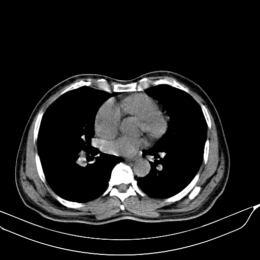 File:Acute pulmonary embolism (Radiopaedia 69510-79390 Axial non-contrast 34).jpg
