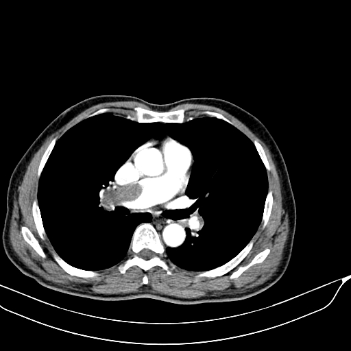 Acute pulmonary embolism (Radiopaedia 69510-79390 D 11).jpg
