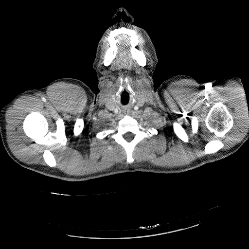 Acute segmental pulmonary emboli and pulmonary infarction (Radiopaedia 62264-70444 Axial C+ CTPA 4).jpg