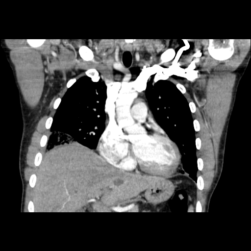 Acute segmental pulmonary emboli and pulmonary infarction (Radiopaedia 62264-70444 Coronal C+ CTPA 18).jpg
