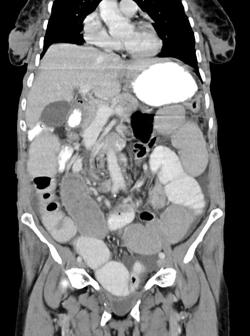 Acute small bowel (ileal) volvulus (Radiopaedia 71740-82139 Coronal C+ portal venous phase 48).jpg