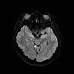 Acute superior cerebellar artery territory infarct (Radiopaedia 84104-99358 Axial DWI 20).jpg