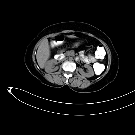 Adenocarcinoma colon with intussusception (Radiopaedia 86006-101922 Axial non-contrast 19).jpg