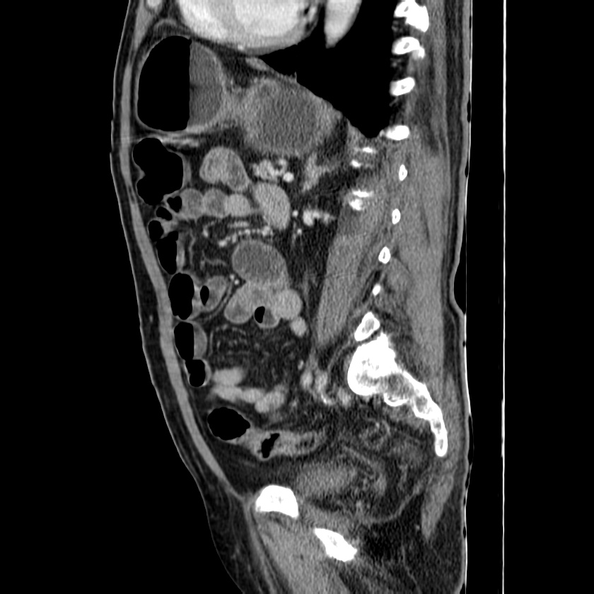 Adenocarcinoma of colon with entero-colic fistula (Radiopaedia 22832-22852 Sagittal C+ portal venous phase 40).jpg