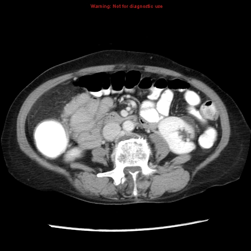 File:Adenocarcinoma of the colon (Radiopaedia 8191-9039 Axial liver window 38).jpg
