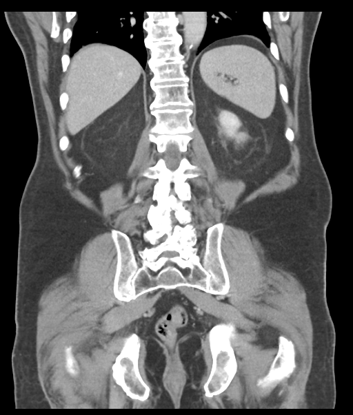 Adenocarcioma of rectum- T1 lesion (Radiopaedia 36921-38547 Coronal C+ portal venous phase 47).png