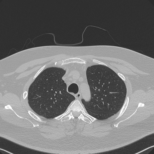 Adenoid cystic carcinoma of the trachea (Radiopaedia 49042-54137 Axial lung window 83).jpg