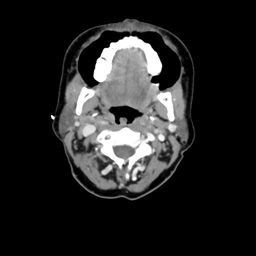 File:Adenoid cystic tumor of palate (Radiopaedia 46980-51518 Axial C+ delayed 32).png