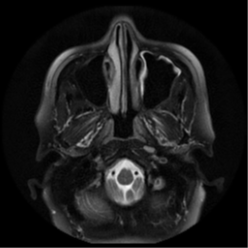 File:Adenoid cystic tumor of palate (Radiopaedia 46980-51519 Axial T2 25).png